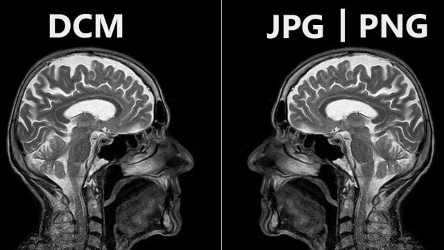 Image of two head MRI scans side by side.